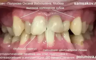 Гематома в стоматологии