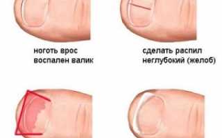 Лечение вросшего ногтя на ноге