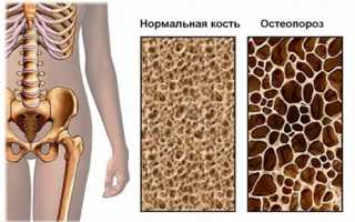 Симптомы и лечение остеопороза бедренного сустава