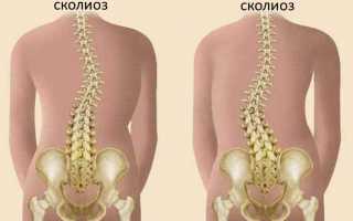 Сколиоз 4 степени: диагностика и лечение