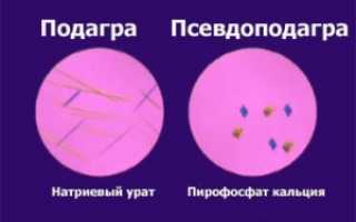 Что такое «псевдоподагра»?