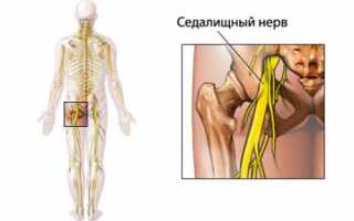 Симптомы и лечение неврита седалищного нерва