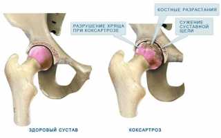Лечение коксартроза тазобедренного сустава