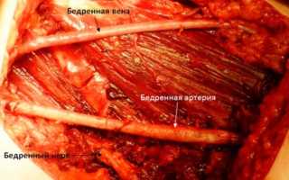 Симптомы, осложнения и лечение повреждения бедренной вены