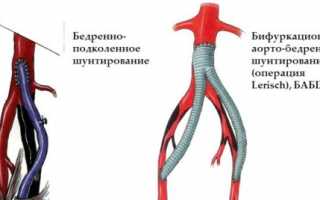 Зачем и в каких случаях выполняют шунтирование сосудов ног?