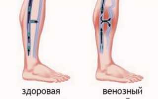 Симптомы и лечение венозного застоя в ногах