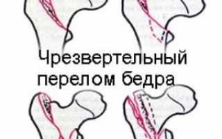 Типы, проявления и терапия чрезвертельного перелома шейки бедра