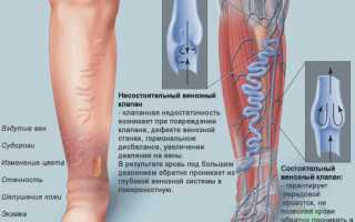 Варикозное расширение вен на ногах: причины, симптомы, лечение