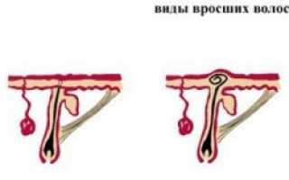 Как убрать вросшие волосы в зоне бикини?