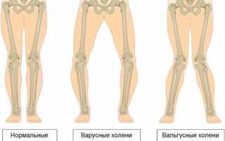 Проявления и терапия вальгусной деформации коленных суставов