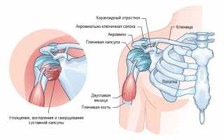 Плечелопаточный периартроз: симптомы и лечение