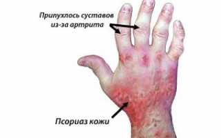 Псориатический артрит: что надо знать об этом заболевании?