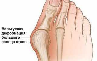Проявления и лечение вальгусной деформации большого пальца стопы