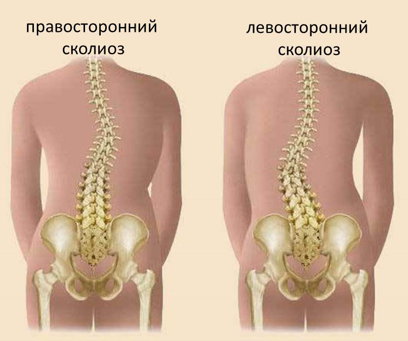 Виды сколиоза