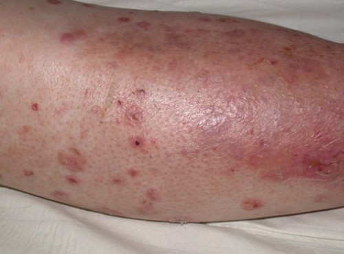 angiopat2