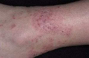 atop-derm