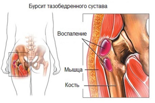 burs-ts