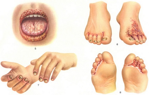 candidiasis-2
