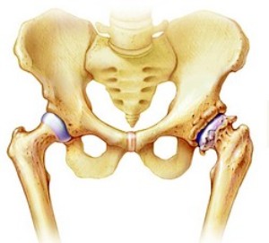 deform-osteoar