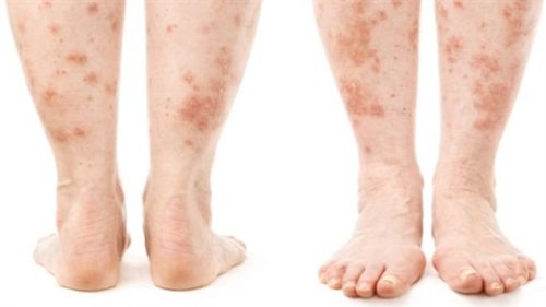 dermatit