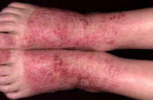 dermatit2