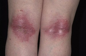 dermatit3