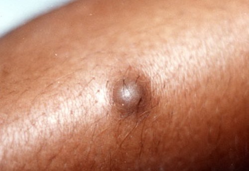 dermatofib2