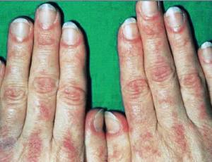 dermatomioz