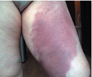 dermatomioz2