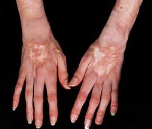 dermatoskl2
