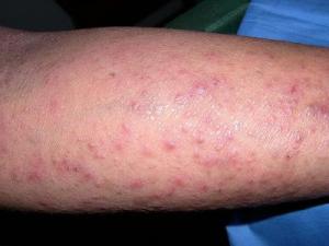 dermatoz