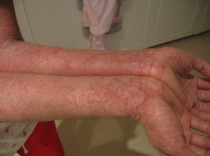 dermatoz2