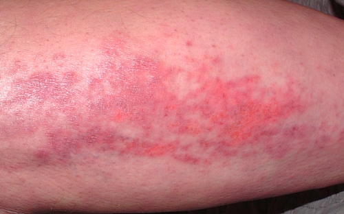 dermatpol
