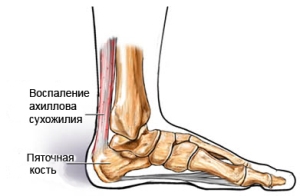 Ахиллодиния