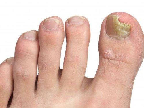 epidermf