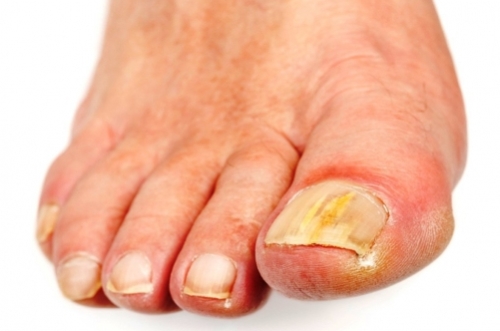 epidermf2