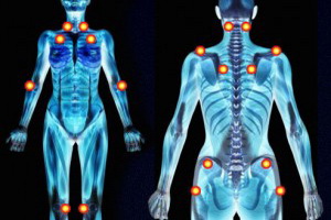 fibromyalgia