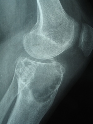 fibrosark2