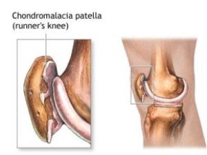 hondromal1