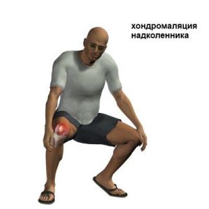 hondromal2