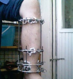ilizarov2