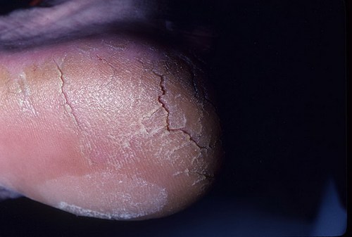 keratoderm