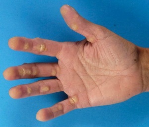 keratoderm2