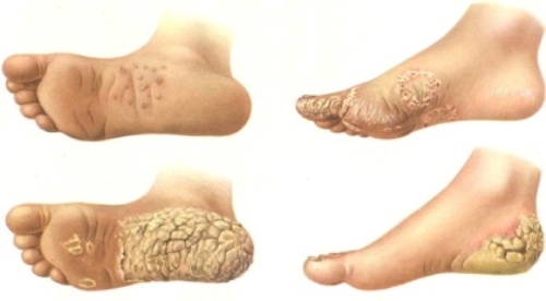 keratoderm3