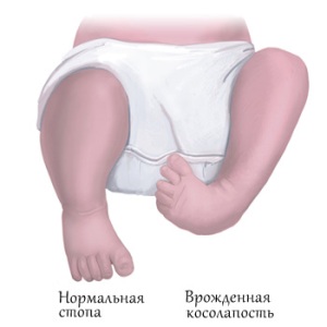 kosolapost