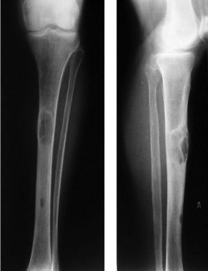 osteod