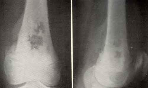 osteogen-sark