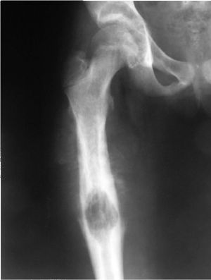 osteogen-sark2