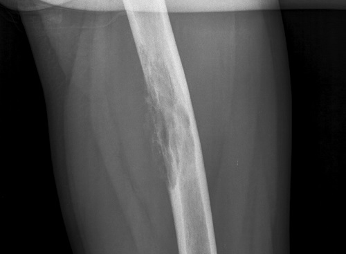 osteom-bedr2