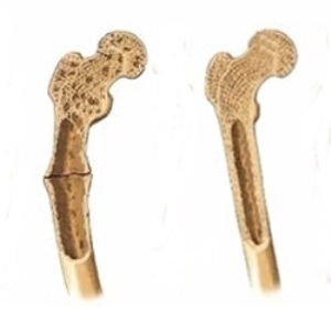 osteomal